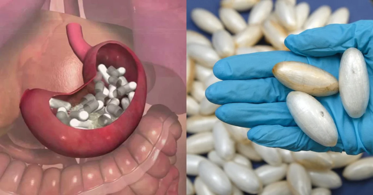 Over 70 Wraps of Cocaine Removed From Stomach of Sierra Leonean National at Indian Airport Over 70 Wraps of Cocaine Removed From Stomach of Sierra Leonean National at Indian Airport